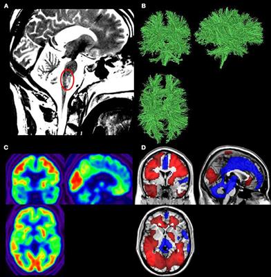 Conscious While Being Considered in an Unresponsive Wakefulness Syndrome for 20 Years